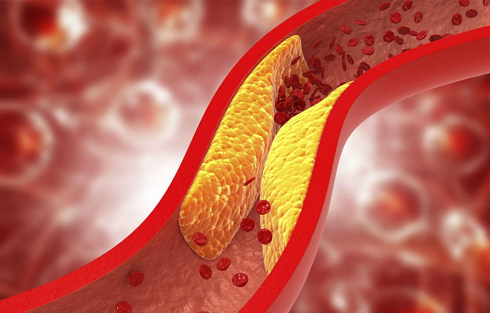 Arteria obstruida por grasa